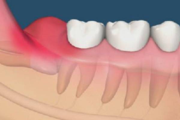 Răng khôn mọc lệch ra ngoài – Hướng về phía má