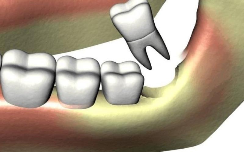 Tiêu xương sau khi nhổ răng khôn – Có đáng lo không?