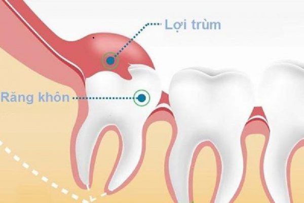 Răng khôn mọc lệch lợi trùm – Nướu phủ lên răng