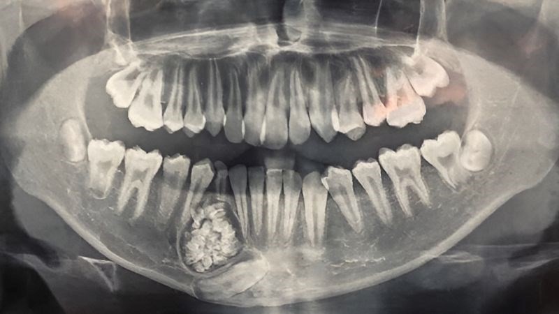 Các Yếu Tố Ảnh Hưởng Đến Chi Phí Mổ Nang Răng