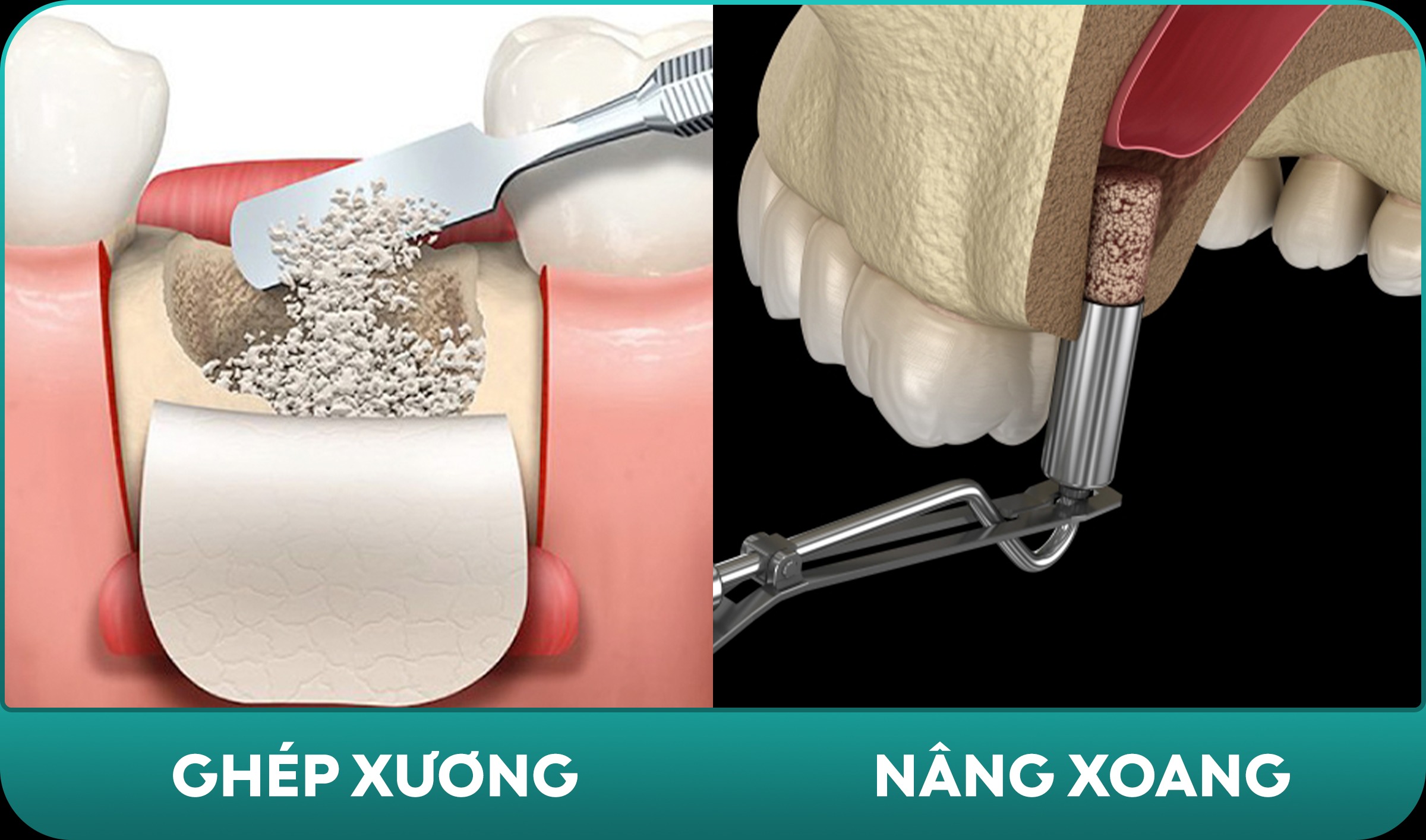 Các kỹ thuật ghép xương, nâng xoan, và tái tạo hiện đại
