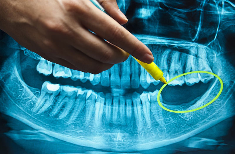 Chẩn đoán tiêu xương hàm bằng kỹ thuật nào?