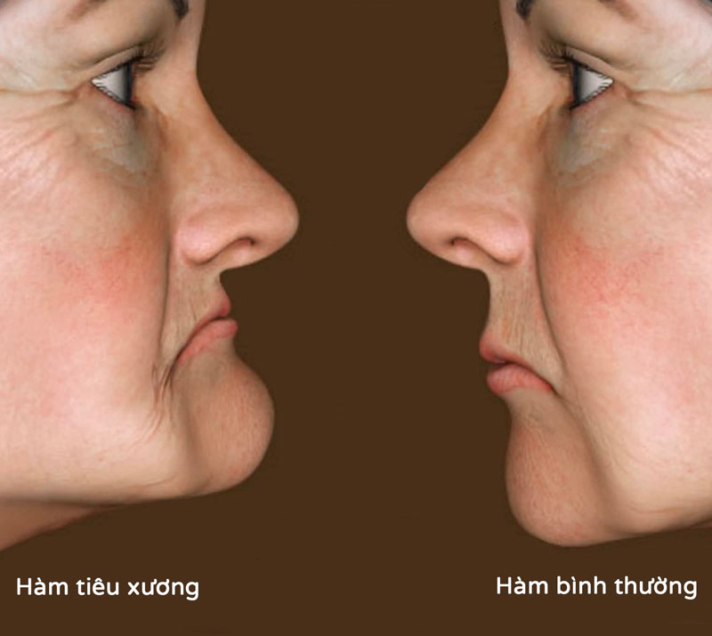 Bao lâu thì tiêu xương hàm sau khi mất răng?