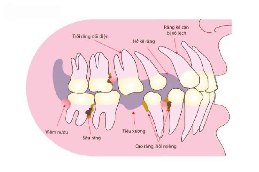 Tiêu xương vùng răng cửa và vùng răng hàm