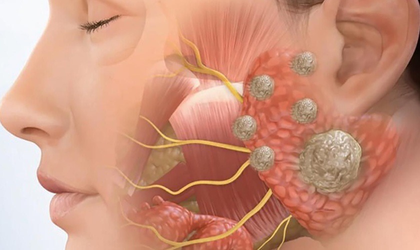 Phân biệt U xương hàm với tiêu xương thông thường