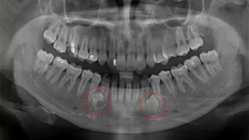 Nang Chân Răng Có Tự Hết Không?