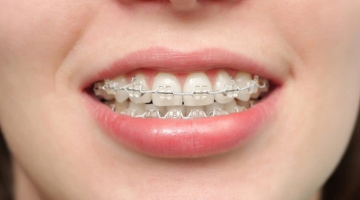 Niềng răng móm do xương có hiệu quả không