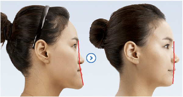 Răng móm khớp cắn ngược là tình trạng gì