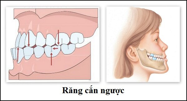 Móm do răng là gì và đặc điểm nhận biết