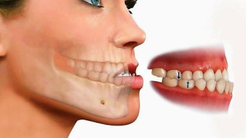 Móm do hàm là gì và khác gì móm do răng