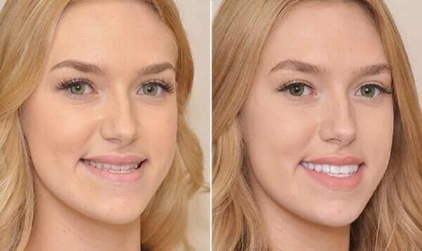 Răng móm nhẹ là gì và có cần điều trị không