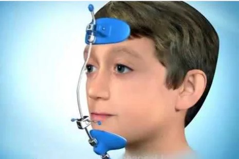 Răng sữa bị móm có tự hết khi thay răng không