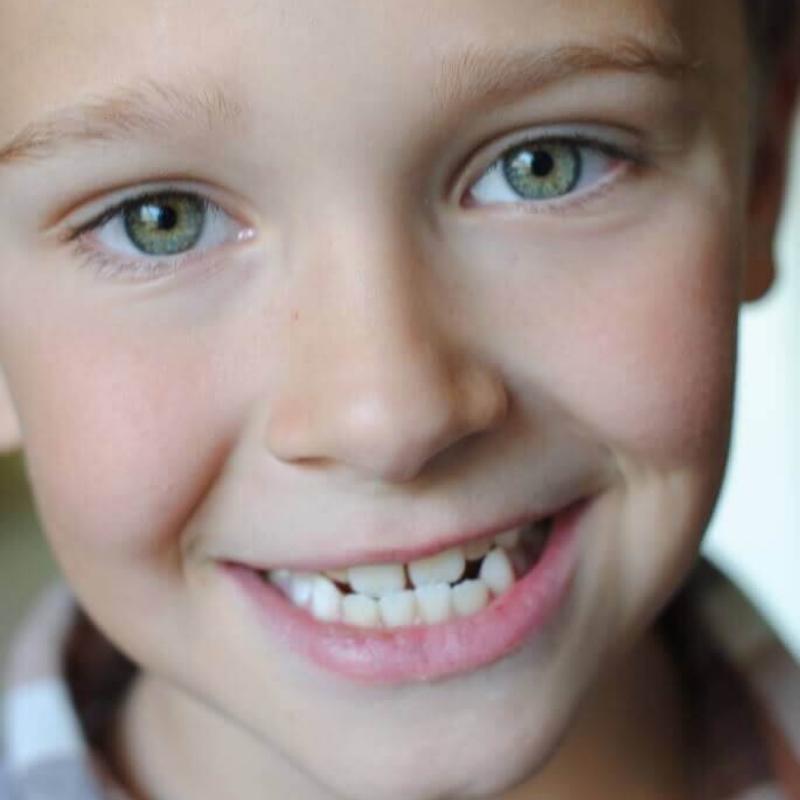 Răng m&oacute;m ở trẻ em do nguy&ecirc;n nh&acirc;n g&igrave;