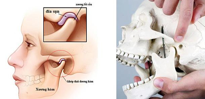 Điều trị viêm khớp thái dương hàm như thế nào?