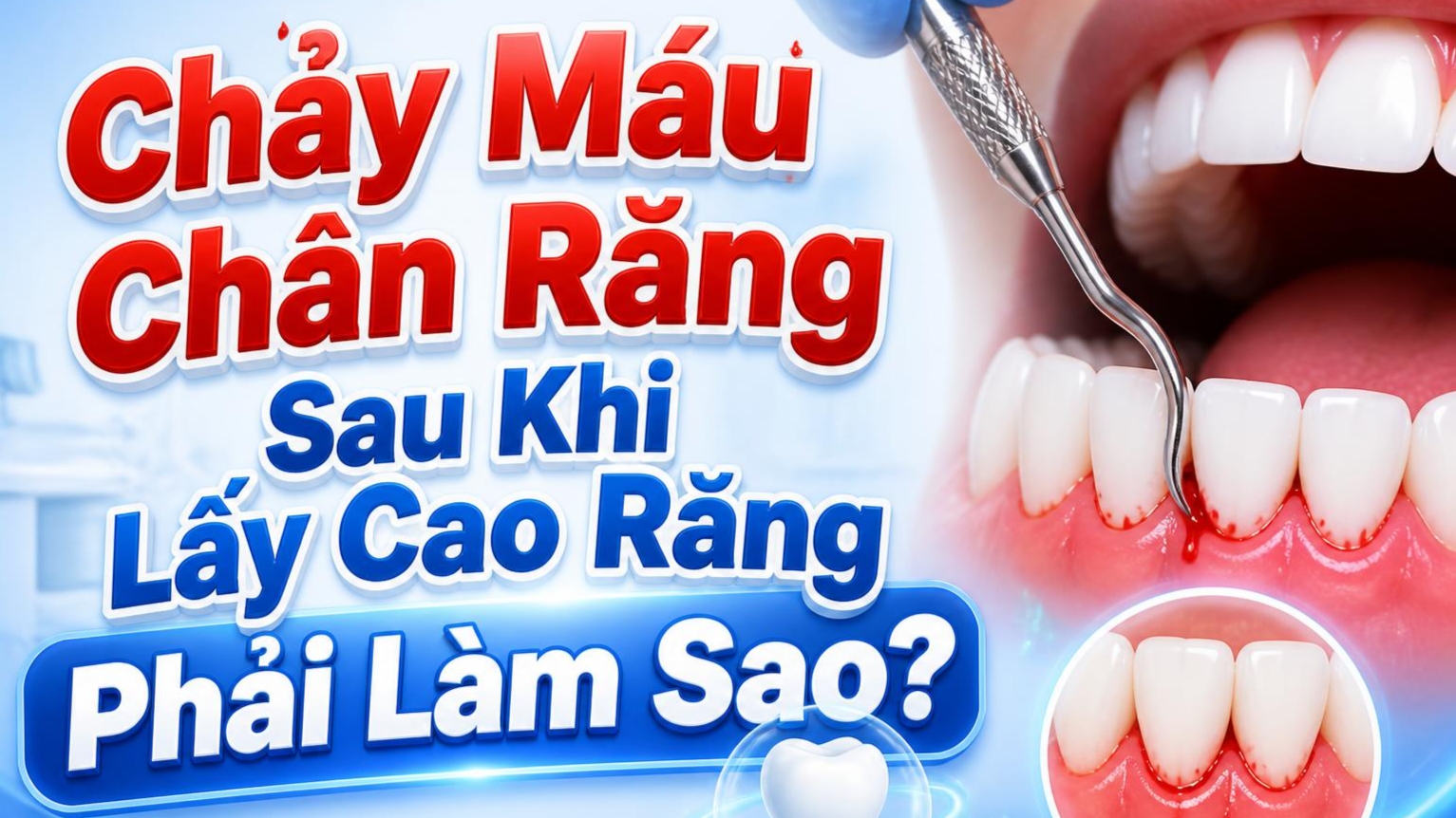 Chảy Máu Chân Răng Sau Khi Lấy Cao Răng Phải Làm Sao? Hướng Dẫn Toàn Diện