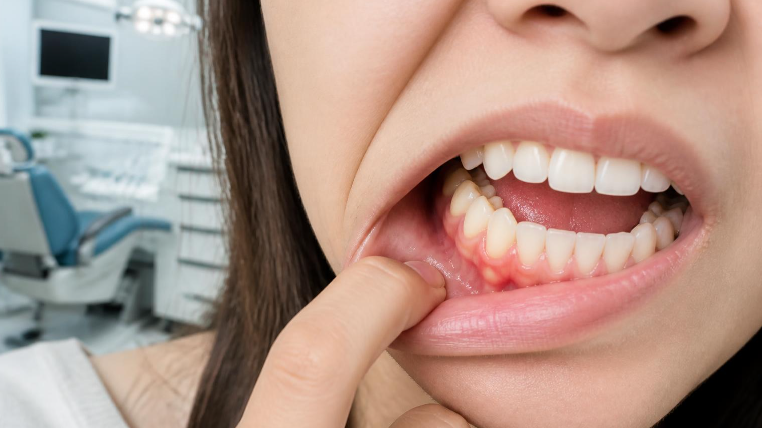 Sưng Nướu Bao Lâu Thì Mọc Răng?