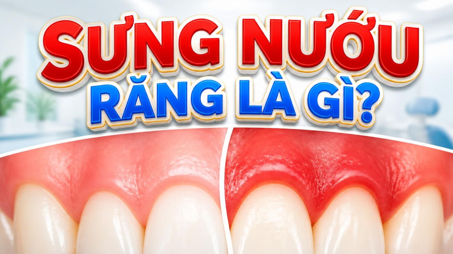 Sưng Nướu Răng Là Gì? Nguyên Nhân Và Cách Điều Trị