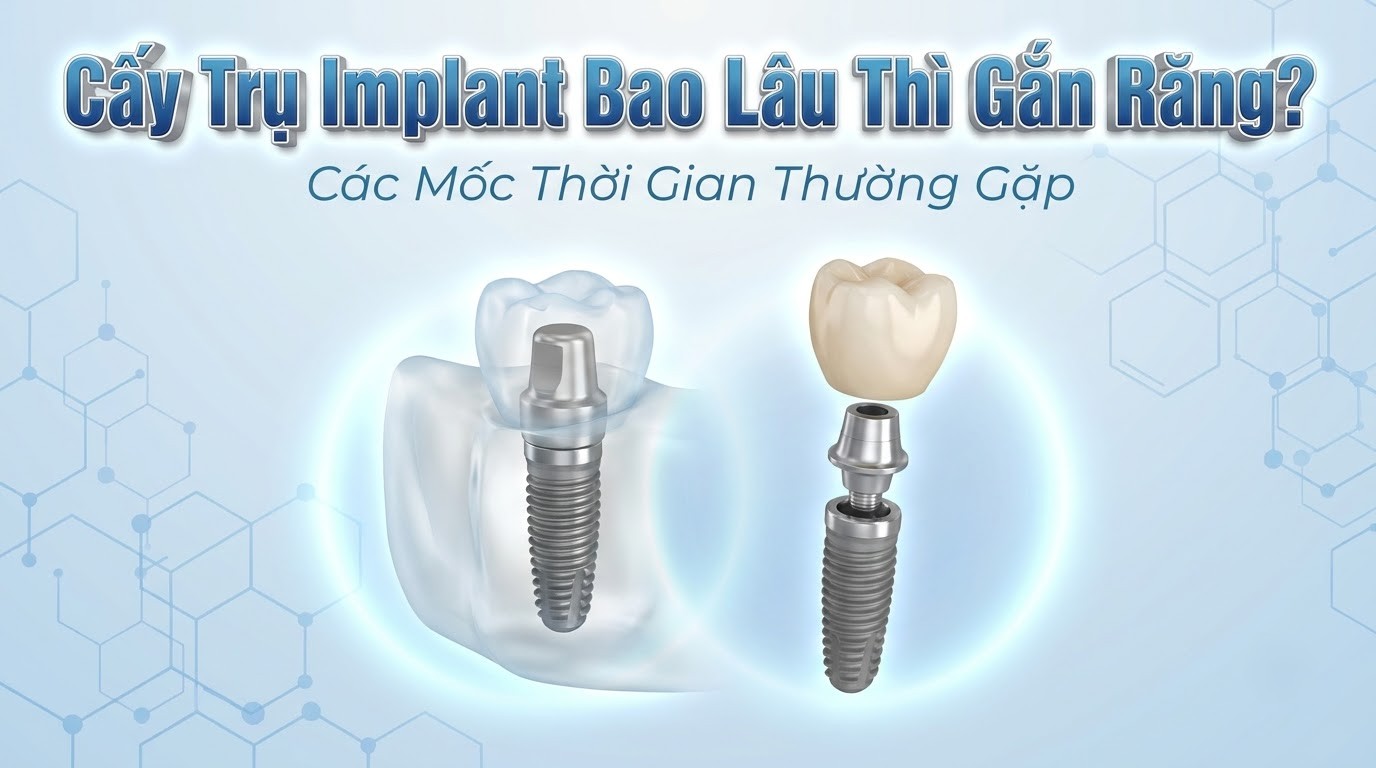 Cấy Trụ Implant Bao Lâu Thì Gắn Răng? Các Mốc Thời Gian Thường Gặp