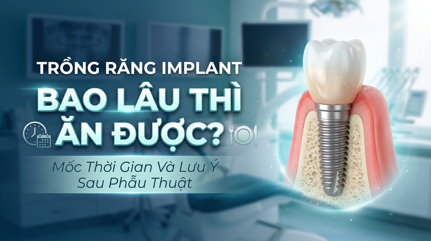 Trồng Răng Implant Bao Lâu Thì Ăn Được? Mốc Thời Gian Và Lưu Ý Sau Phẫu Thuật